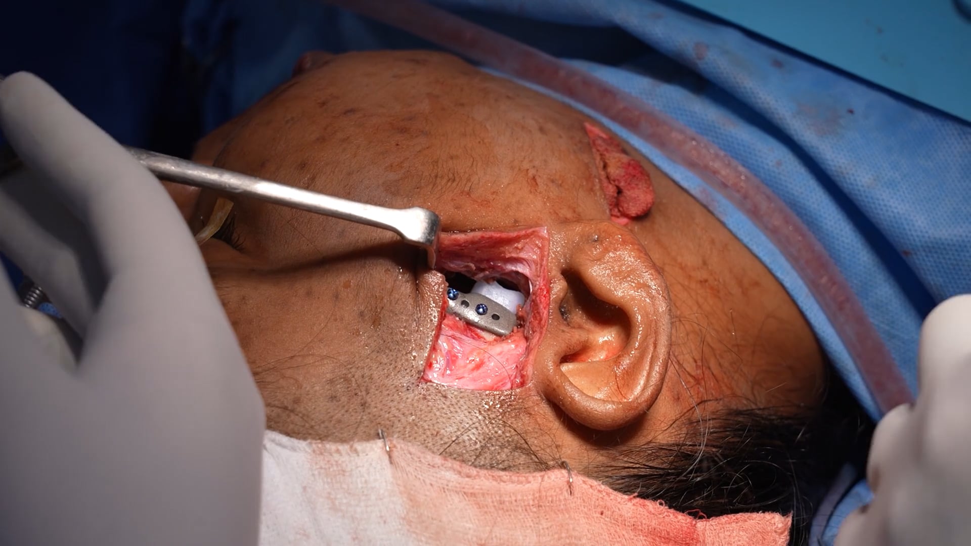 Temporomandibular Joint Replacement Surgery
